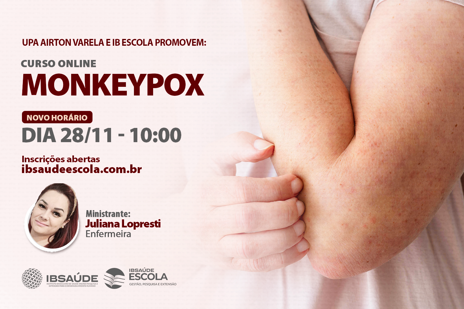 Monkeypox